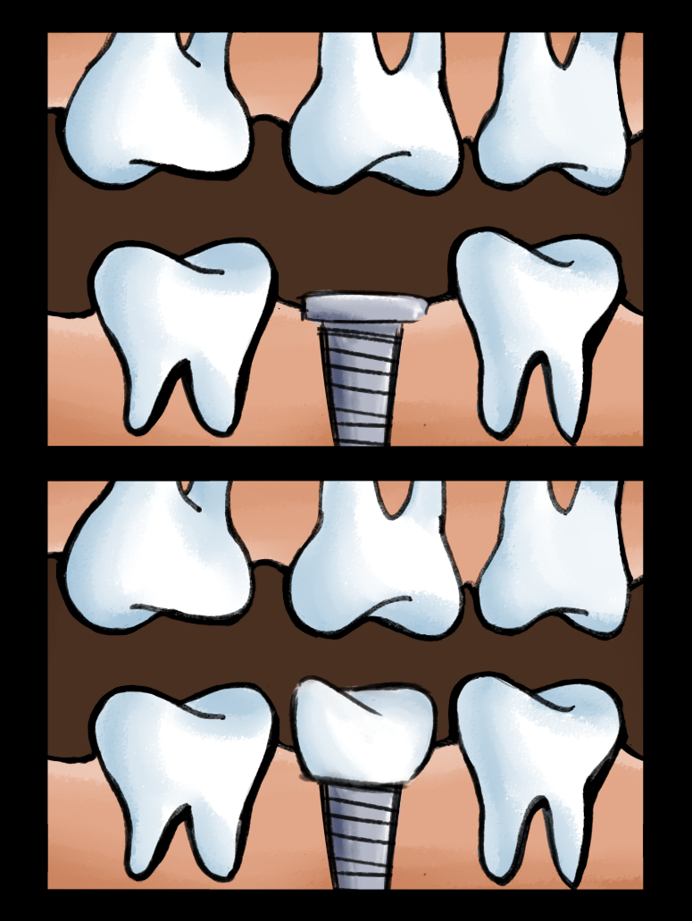 How Dental Implants Work